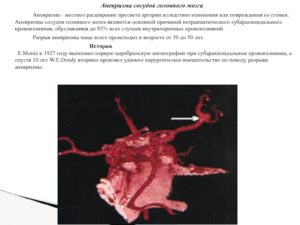 Аневризма основной артерии головного мозга