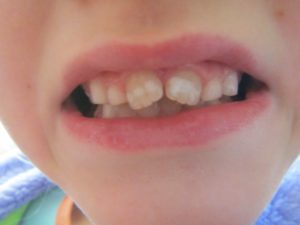 Пятна на коренных зубах у ребенка