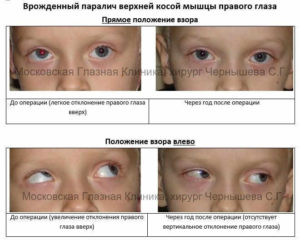 Парез прямых мышц глаза (левого) и ркт