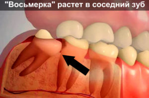 Зуб растет растет в бок