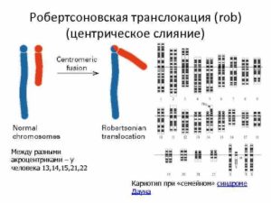 Робертсоновская транслокация 13,14 хромосомы