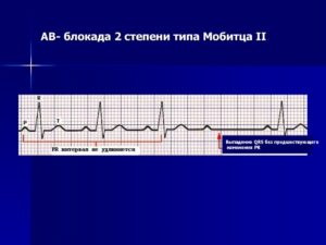 Эпизоды АВ-блокады 2 ст. 2 типа