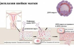 Дисплазия и ВПЧ 16 типа