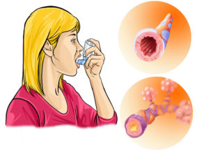 Затрудненное дыхание без кашля, подозрение на аллергию