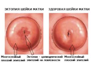 Шейка матки гиперемирована в области наружного зева