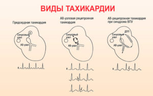 Как вылечить тахикардию раз и навсегда