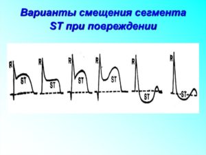 Смещение сегмента ST