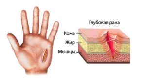 Глубокий порез ладони