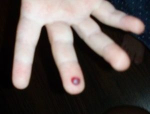 Кровяной пузырь на пальце руки