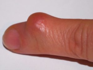 Шишка на пальце после ушиба