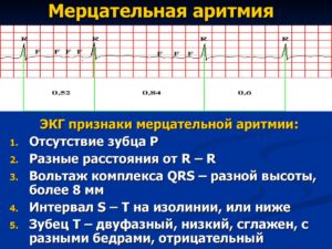 Мерцательная аритмия вагусного типа