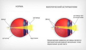 Миопический астигматизм и роды