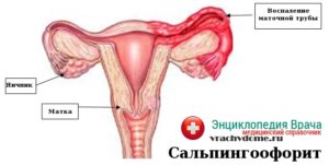 Обострение сальпингоофорита