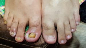 Незаживающая рана на большом пальце ноги