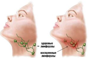 Высокая температура, покраснение кожи после температуры, лимфоузлы