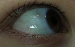 Черная точка на белке глаза
