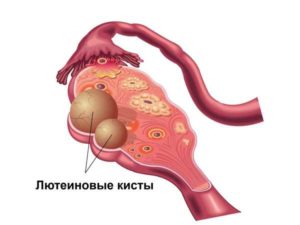 Киста желтого тела, задержка месячных