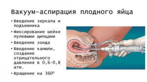 Остатки после мини аборта