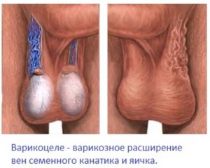 В мошонке левое яичко ниже правого