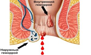 Шишка возле ануса, вспухшая кожа вокруг ануса