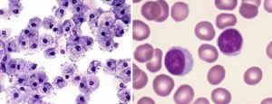 Атипичные лимфоциты и плазматические клетки