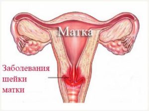 Боли внизу живота при эрозии