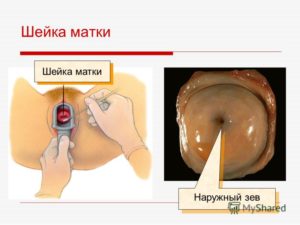 Шейка матки гиперемирована в области наружного зева