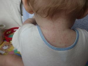 Ужасная сыпь у ребенка на плечах, шее
