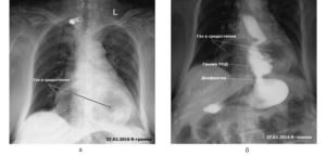Рентген показал грыжу пищевода