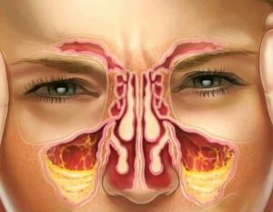 Боль между носом и верхней губой, насморк