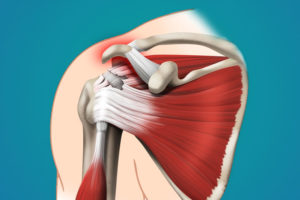 Повреждение сухожилия надостной мышцы