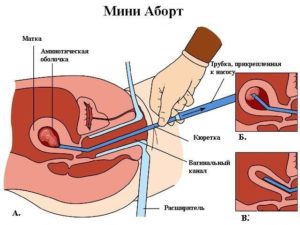 14 дней идет кровь после хирургического аборта