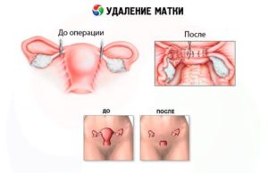 Климакс после удаления матки