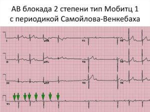 СССУ, БЛОКАДА самойлова венкебаха