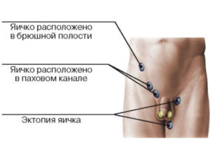 Крипторхизм, мошонка, яички, гормоны