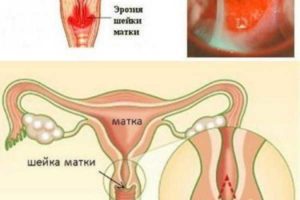 Половая жизнь при эрозии