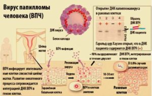 Дисплазия и ВПЧ 16 типа