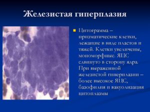 Гиперплазия железистого эпителия
