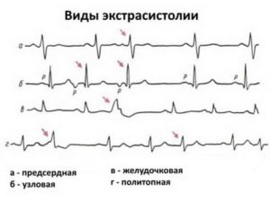 Невроз и экстрасистолы