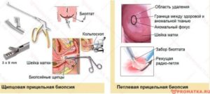 Менструация после биопсии