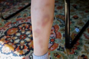 Стали появляться синяки на ногах у ребёнка в 8 лет