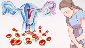 Обильные и непрекращающиеся месячные после Регулона