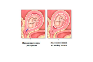 Прорезывание швов на шейке матки при беременности