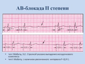 Эпизоды АВ-блокады 2 ст. 2 типа