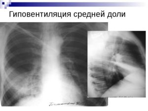 Рентген легких, гиповентиляция нижней доли лёгкого