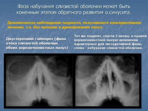 Инфильтративно-воспалительные изменения слизистой обеих верхнечелестной пазухи носа