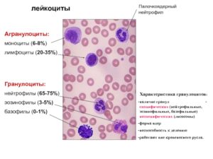 Отсутствие в крови базофилов и эозинофилов