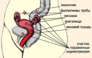 Кишечник или яичники