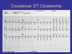 Что значит снижение сегмента ST