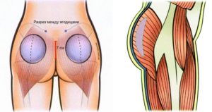 Мышечные впадины на ягодице